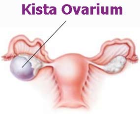 Obat Tradisional Kista Ovarium